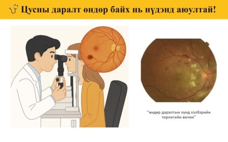 🩺 Цусны даралт өндөр байх нь нүдэнд аюултай! 👀