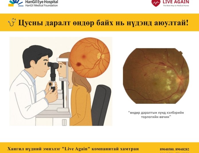 🩺 Цусны даралт өндөр байх нь нүдэнд аюултай! 👀