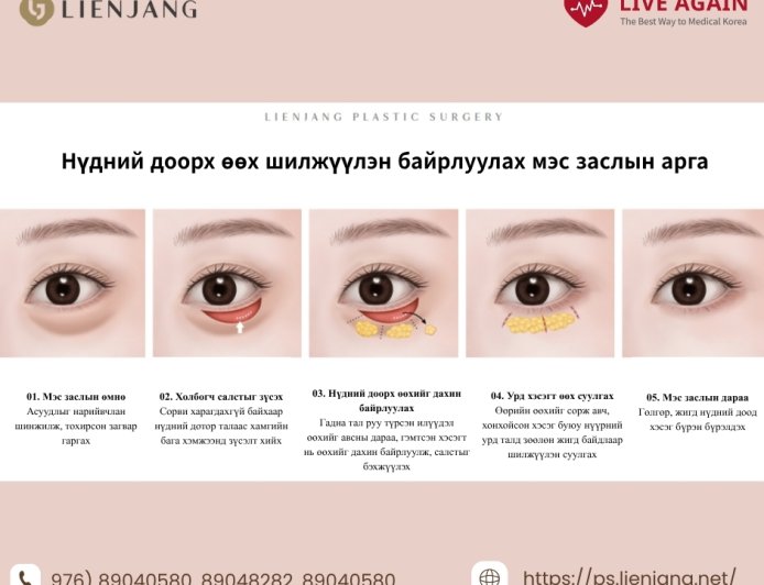 💎 3 Алхамт Нүдний Доорх Өөх Шилжүүлэн Байрлуулах Мэс Засал