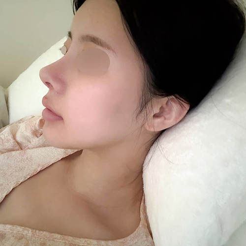 코재수술,안면윤곽 같이 받았습니다!