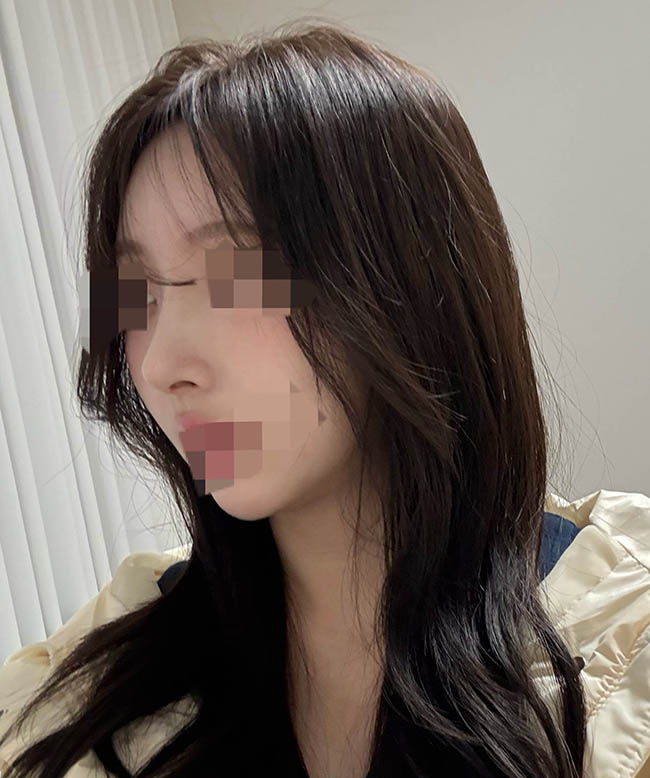 자가늑 코수술 대만족이에용 >< ㅎㅎ