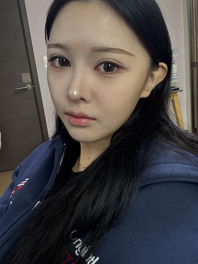 코재수술하니까 셀카 찍을맛나요 :)