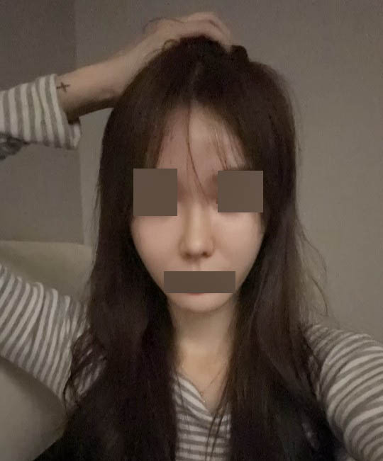 두번째 코수술 원트에서 성공했어요 ^^