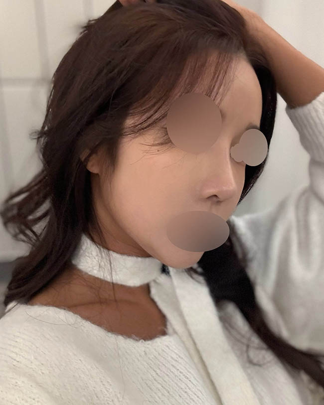 낮은휜코 개선하고 싶어서 재수술 받게 됐어요