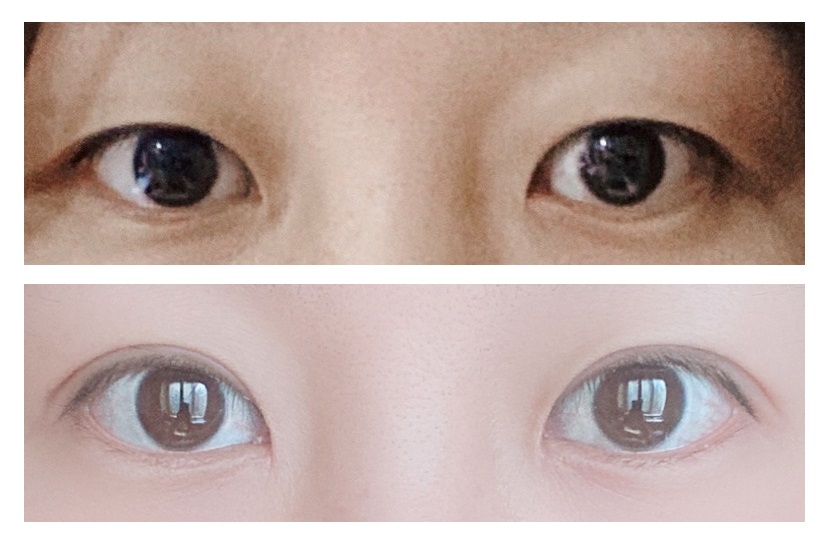 Давхар зовхины мэс заслын 3 сарын дараах сэтгэгдэл