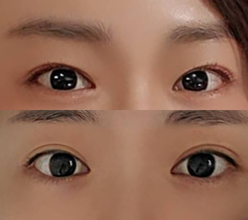 Нүдний дахин хагалгаа