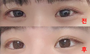 Давхар зовхины мэс засал амжилттай боллоо