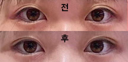 Булгараар мэс засал хийлгэсэн!