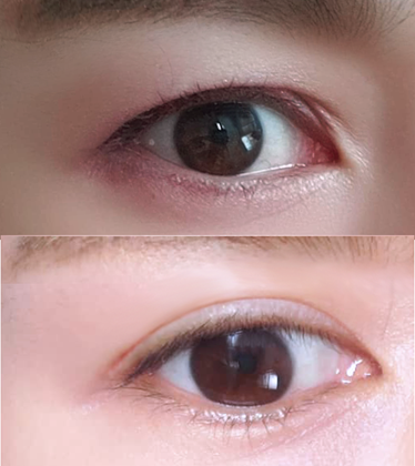 Зүсэлттэй зовхины заслын үр дүнд сэтгэл хангалуун байна!