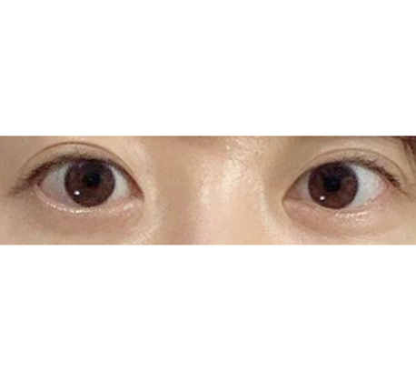 Нүдний хэлбэр засал маш гоё болжээ!