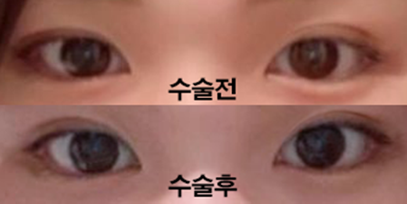 Давхар зовхины дахин мэс засал хийлгэснээс хойш 3 сар болж байна!