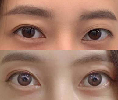 Давтан хагалгааны 6 сарын дараах сэтгэгдэл