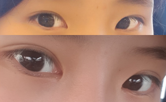 Өмнөд зовхи, давхар зовхины дахин мэс заслын 2 сарын дараах сэтгэгдэл~