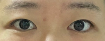 Зүсэлттэй хос зовхи, урд зүсэлт хийлгэсний дараах 5 сарын тойм