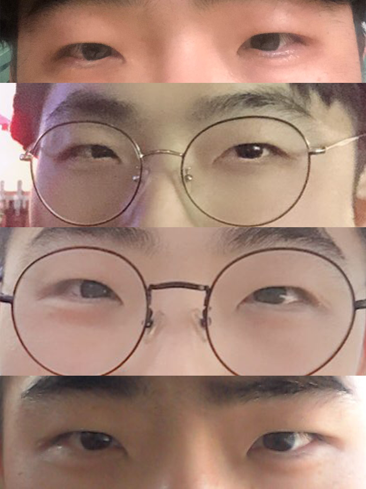 Нүдний хэлбэр засах мэс (зүсэлттэй)+өмнөх зовхины мэс ажилбарын дараах сэтгэгдэл