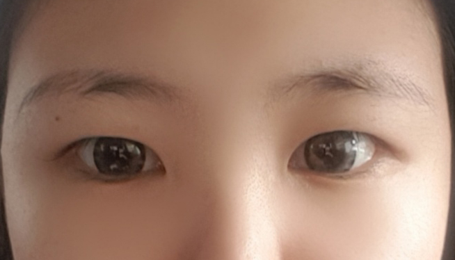 Зүсэлттэй зовхи засвар хийлгээд 4 сар боллоо