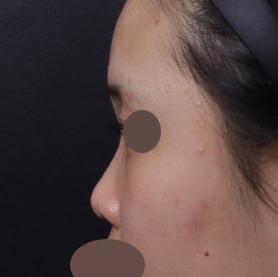 다들 베리굿성형외과에서 코성형하세욧!