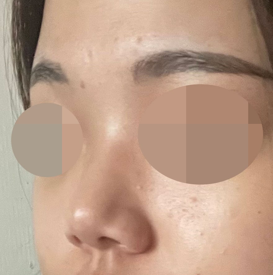 짧은 코에 낮은 콧대 너무 신경쓰여서 수술 결정하게 되었습니다!
