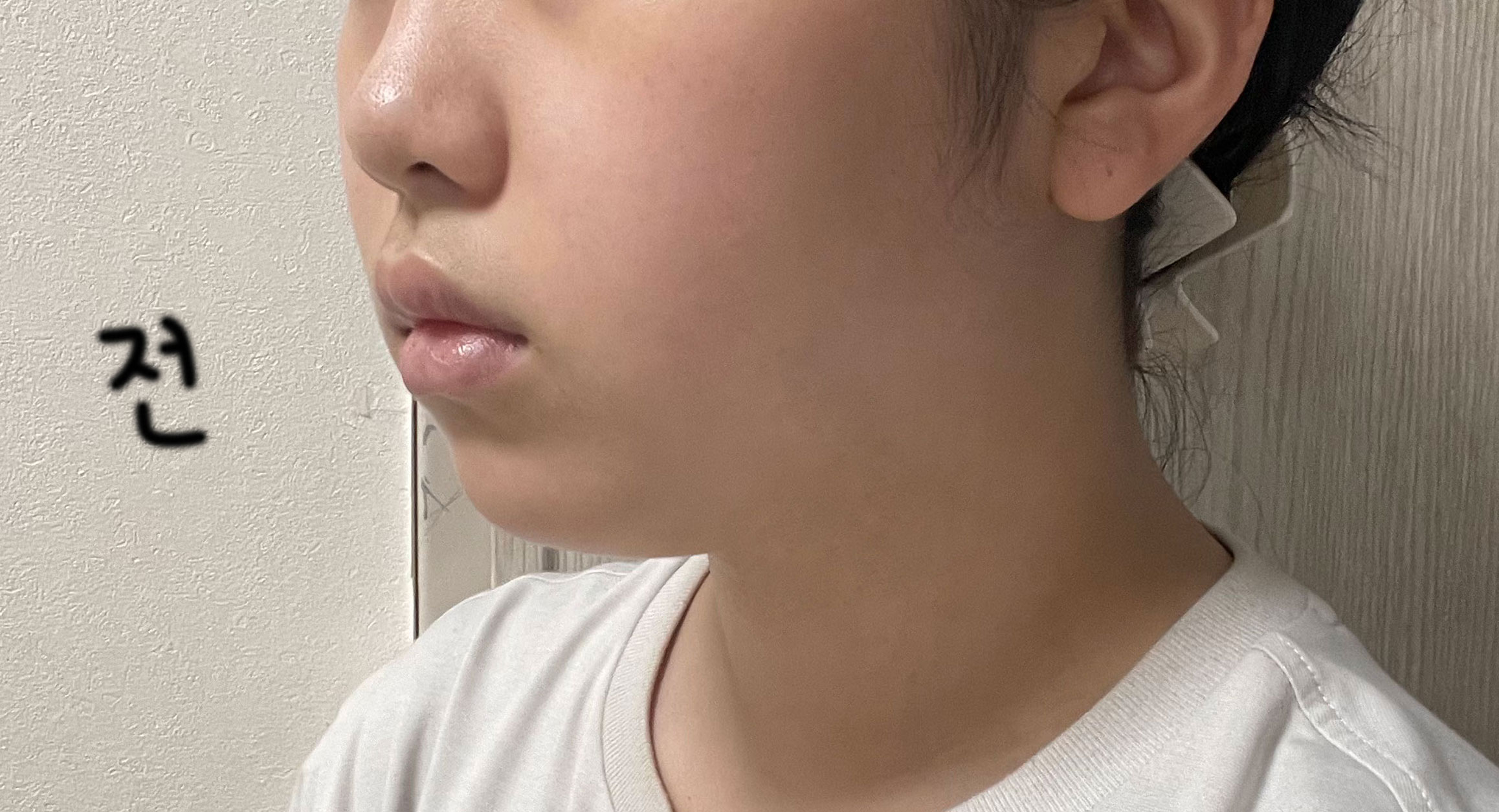 얼굴선이 많이 정리되고 빠진거 같아 만족합니다