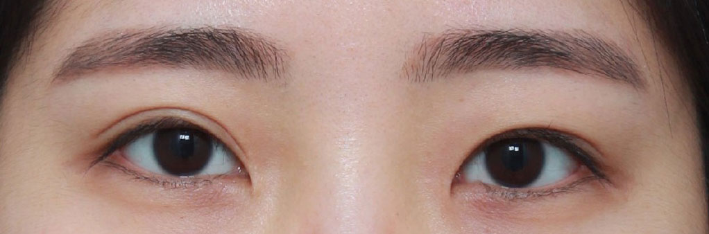 ​눈성형(눈재) 3개월차 후기,,,