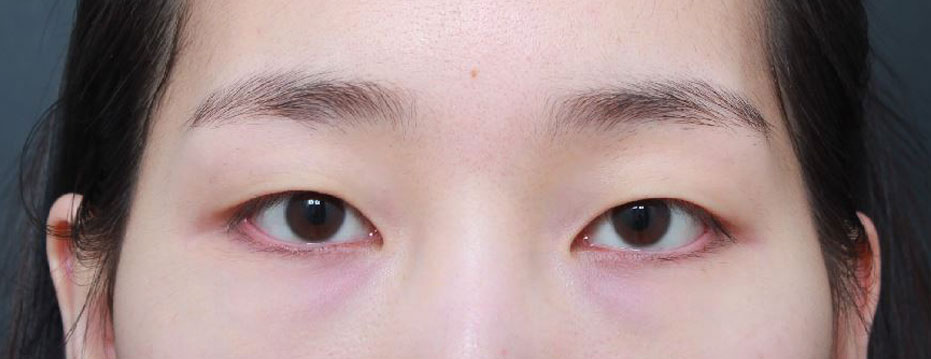 이전부터 계속 수술 고민했었는데 하길 너무 잘한 것 같아요!