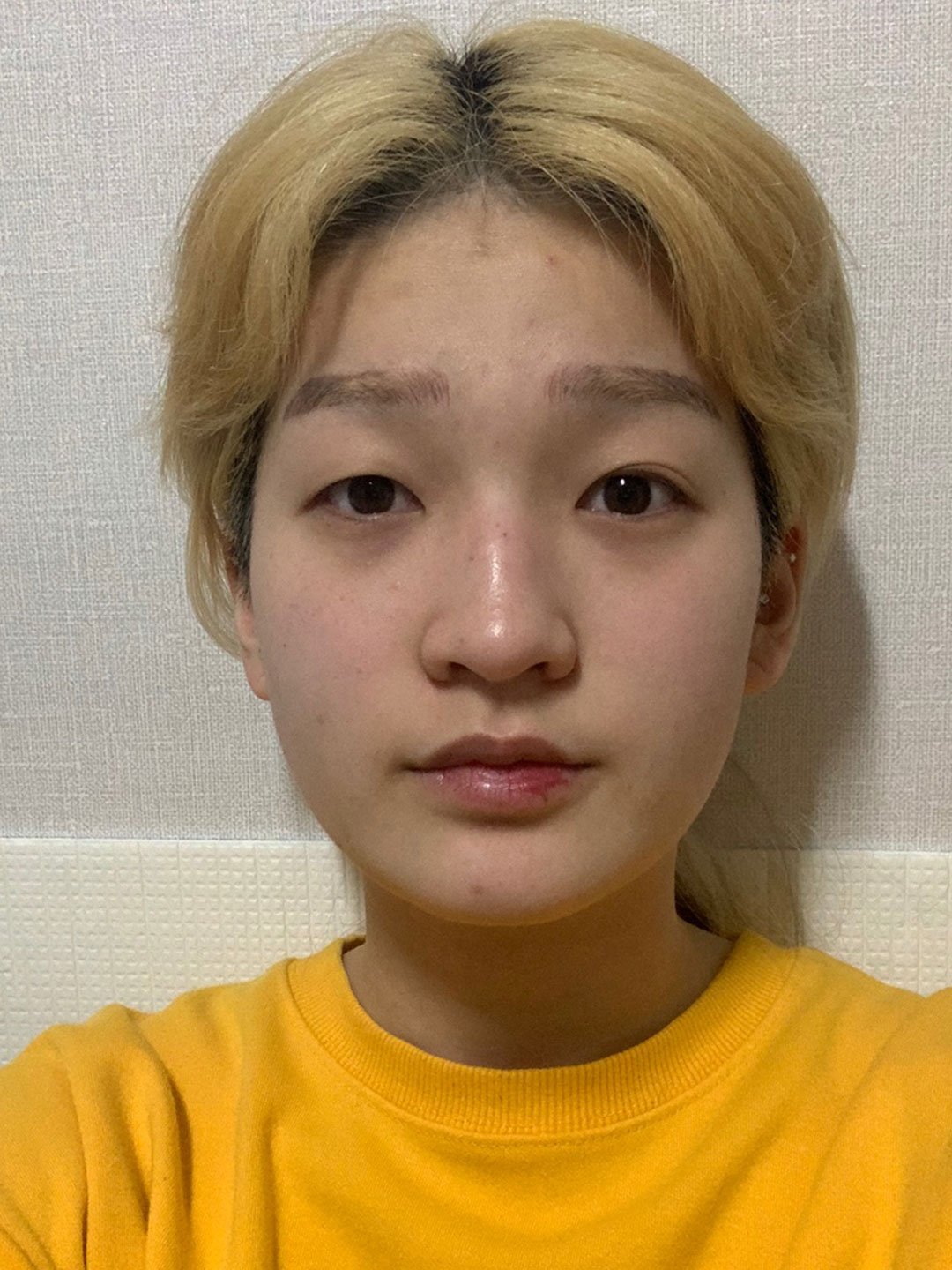 수술한지 4개월 , 화장이 필요 없어요!!