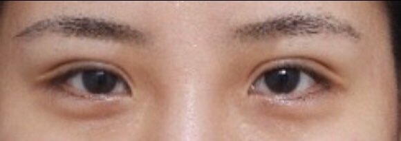 소세지 눈아 이제 안녕~​