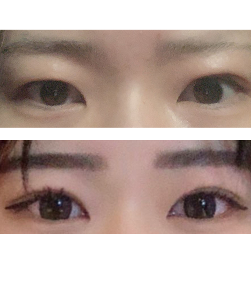 쌍커풀 수술을 하고 지금 너무 맘에 들어서 좋아서 게시글 올린다