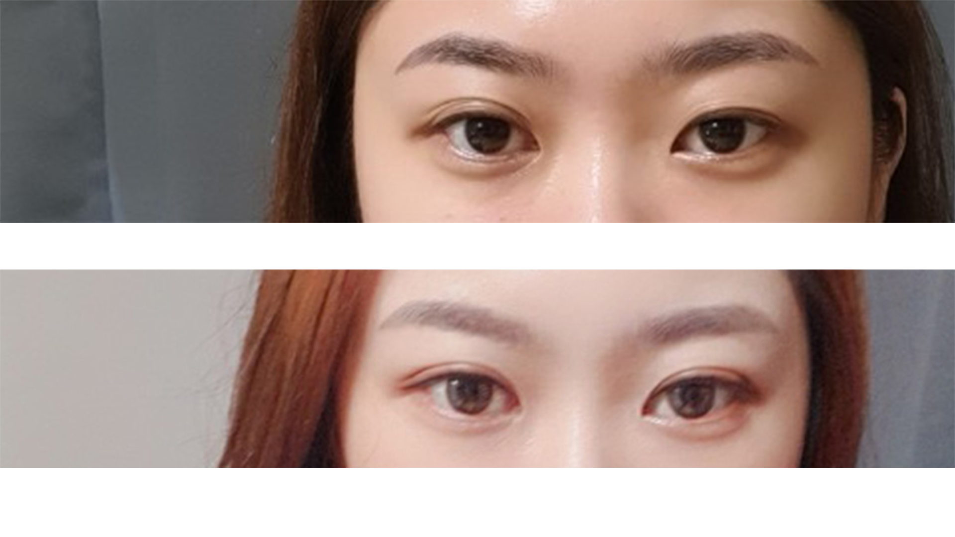 베리굿에서 첫 쌍커풀수술한지 3개월정도 지났어요 후기남겨드립니다~