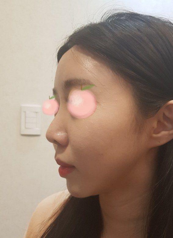 자가늑연골 코 했어요 현재 넘 만족하면서 지내고 있어요ㅋㅋㅋㅋ