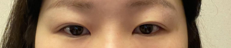 눈 | 코 재수술 수술후기