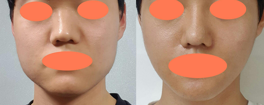 안면윤곽 수술후기