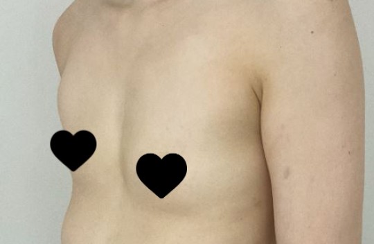 가슴수술 후기입니다.