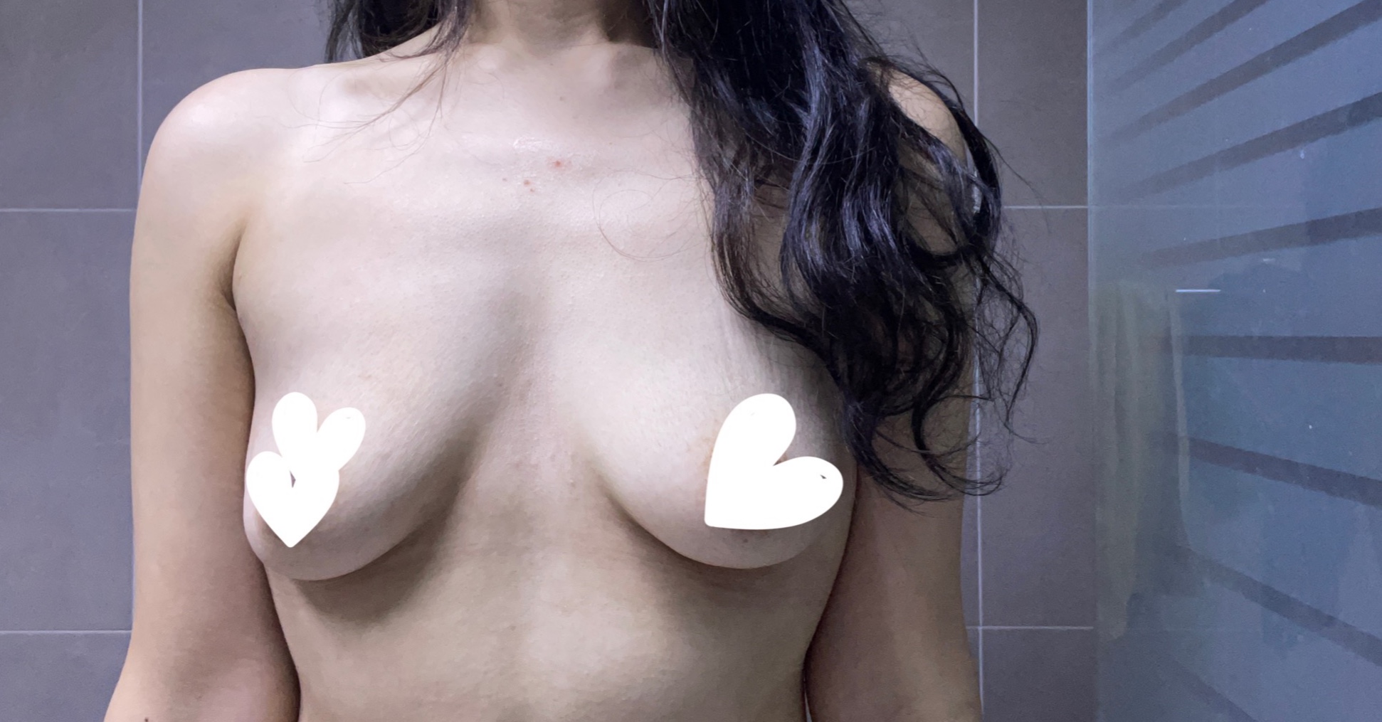 세빈 서브리미티 395cc,밑절 쳐진가슴 올리기!