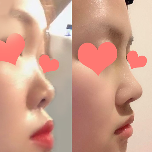 Хамрын мэс заслын дараах сэтгэгдэл!!