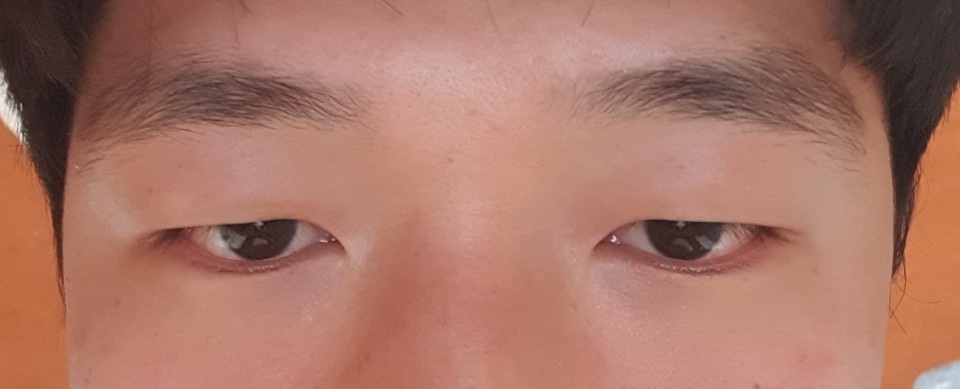 Зүсэлттэй нүдний хэлбэр засах