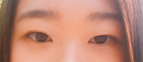 Зүсэлгүй булшлах давхраа үүсгэх мэс заслын тойм!