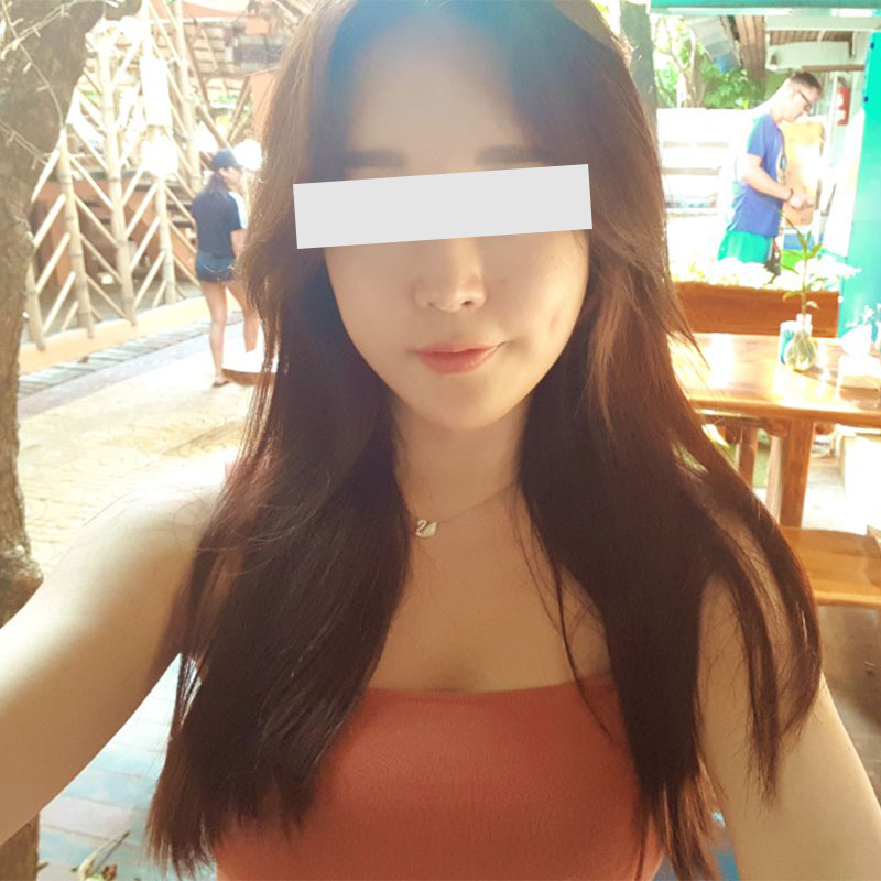 ★Хацрын ясыг багасгах мэс заслын дараах 1 жил хагасын тойм★