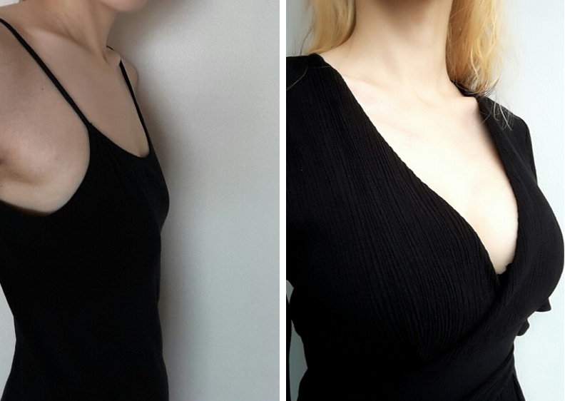 #Хөхний_томруулалт