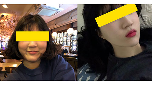 Нүүрний хэлбэр засах - Шанаа багасгах мэс засал хийлгэсэн!