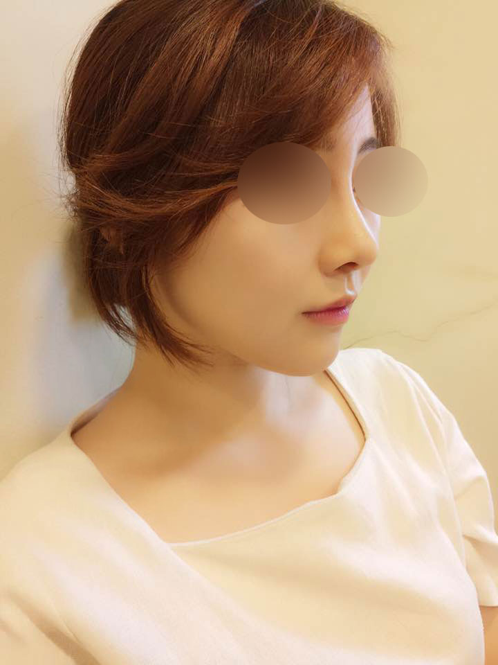 Хамрын нуруу, хамрын үзүүр, эрүүний имплант, Сувдын лазер