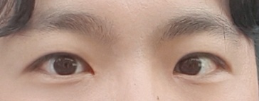 Эрэгтэй хүний нүдний хэлбэр засах мэс засал (өмнөд хэсгийг оруулаад, зүсэлт)