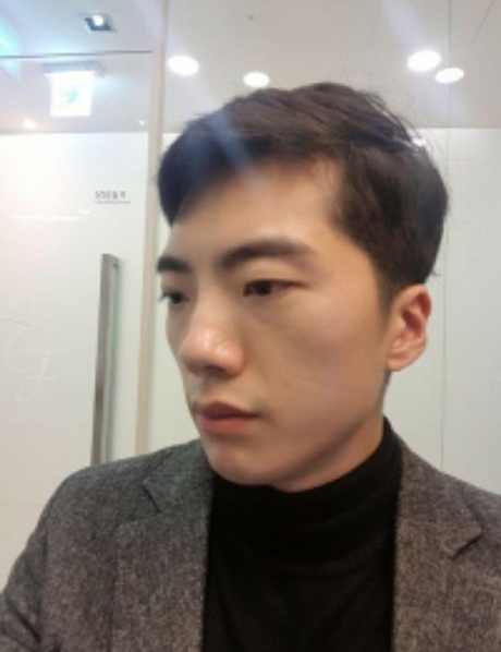 Нүүрний хэлбэр, нүд, хамар засварласнаас хойш 6 сар!