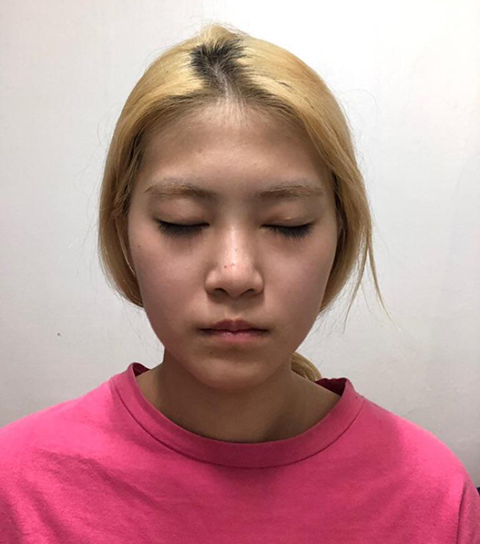 Жейжүн гоо сайхны мэс заслын эмнэлэгт хагалгаа хийлгэснээс хойш 3 сар боллоо!!