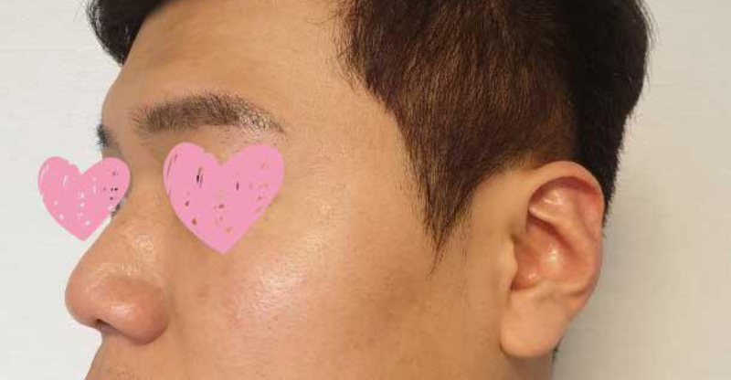 Хамрын нуруу, үзүүр, том хамар засах, бөгтөр хамар