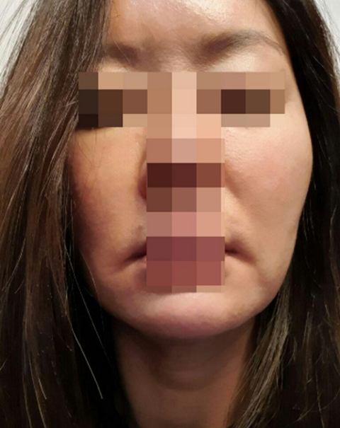 Нүдний доорхи өөх шилжүүлэн суулгах, нүүр өргөх