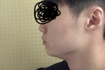 Дөрвөлжин эрүү, хацрын ясыг багасгах, кортикаль зүсэлт, эрүүний ботокс