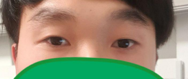 Нүдний хэлбэр засах хэсэгчилсэн зүслэг, нүдний арьс сунгах мэс засал хийлгэсэн.