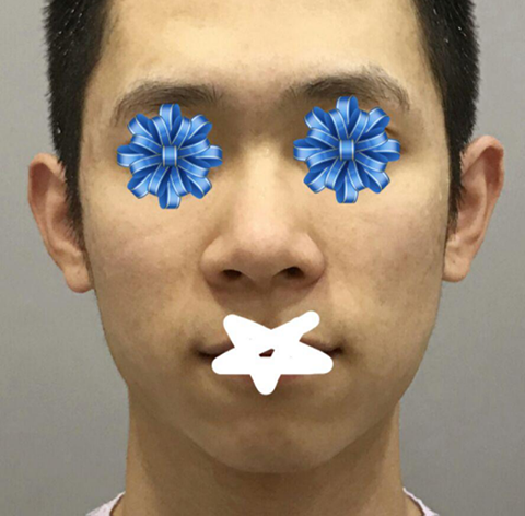 Эрэгтэй хүний хамар, нүүрний хэлбэр зассаны дараах сэтгэгдэл