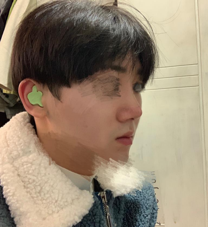 Хамрын дахин мэс засал (хамрын нуруу, үзүүр), хамрын далавчийг багасгах